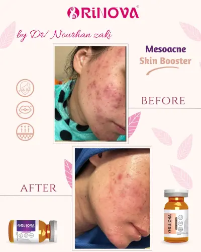 رينوفا MESOACNE | ميزوثيرابي احترافي لعلاج حب الشباب وآثاره والبشرة الدهنية | Rinova MESOACNE - صورة إضافية