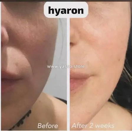 Hyaron Skin Booster هيارون الكوري سرّ البشرة النضرة والممتلئة - YASSO STORE