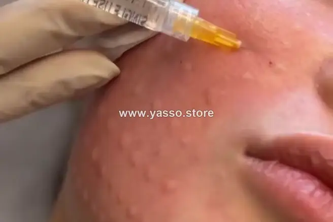 سكين بوستر فينتو عنبر بحمض السكسينيك والهيالورونيك لنضارة وتجديد البشرة (10 مل) - Vinto Amber Skin Booster - YASSO STORE